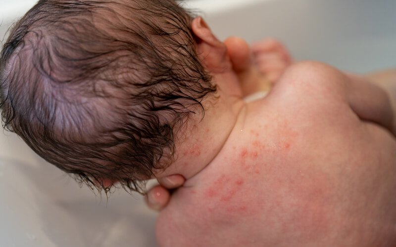 赤ちゃん 温まる と 湿疹